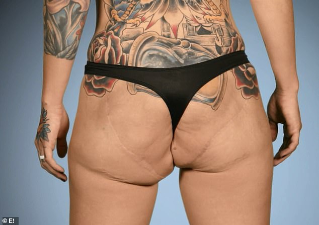 Yikes: Not only did she need to have the injections removed to save her life, but the surgery also left her with unsightly excess skin that can be seen from the front