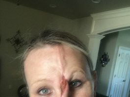 Rebekah Rupp, 41, from Morrison, Oklahoma, was left with a gaping hole in her nose after developing skin cancer from years of tanning bed use